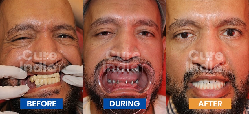 Full-Dental implants before and after Case 4